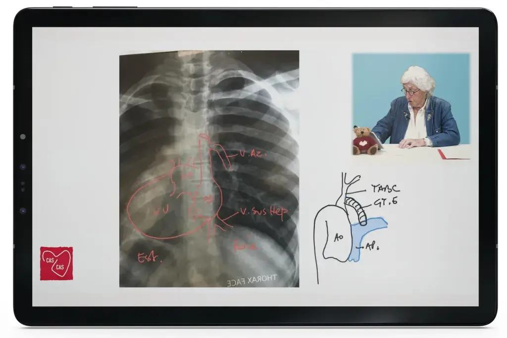 tablette-formation-5-sur-5-mecenat-chirurgie-cardiaque.webp